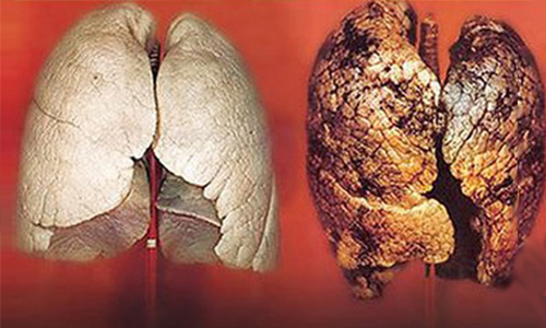 Hút thuốc lá nguyên nhân chính gây ung thư phổi