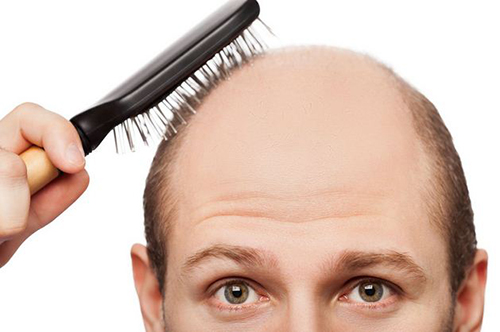 Trị hói tóc hiệu quả bằng bài thuốc y học cổ truyển